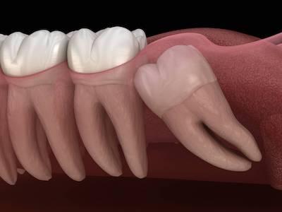 Image of impacted wisdom tooth, nashville tn