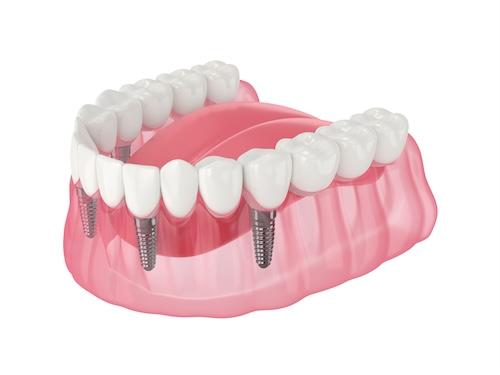Image of snap-in dentures, nashville tn