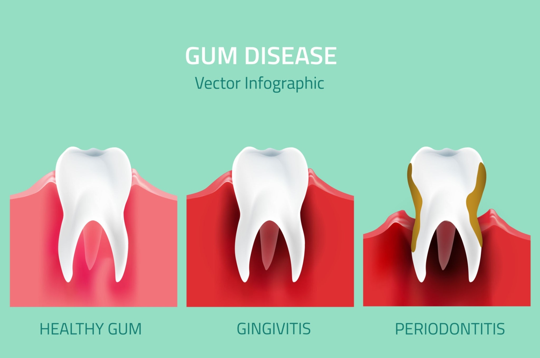 Gum recession early stages graphic, brentwood tn