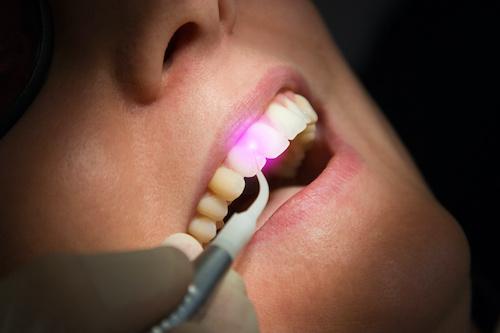 Woman getting her teeth cleaned, nashville tn