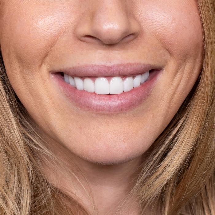 Woman smiling with porcelain veneers, nashville tn