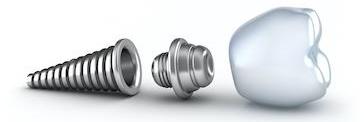image of a dental implants in brentwood tn 