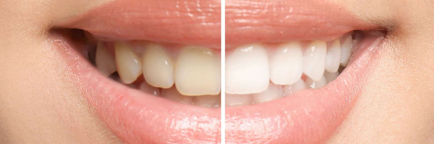 Before and after image of teeth using teeth whitening, brentwood tn