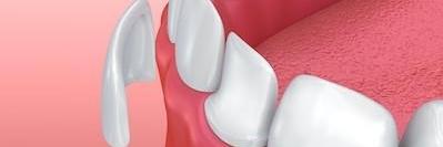 image of porcelain veneers in brentwood tn