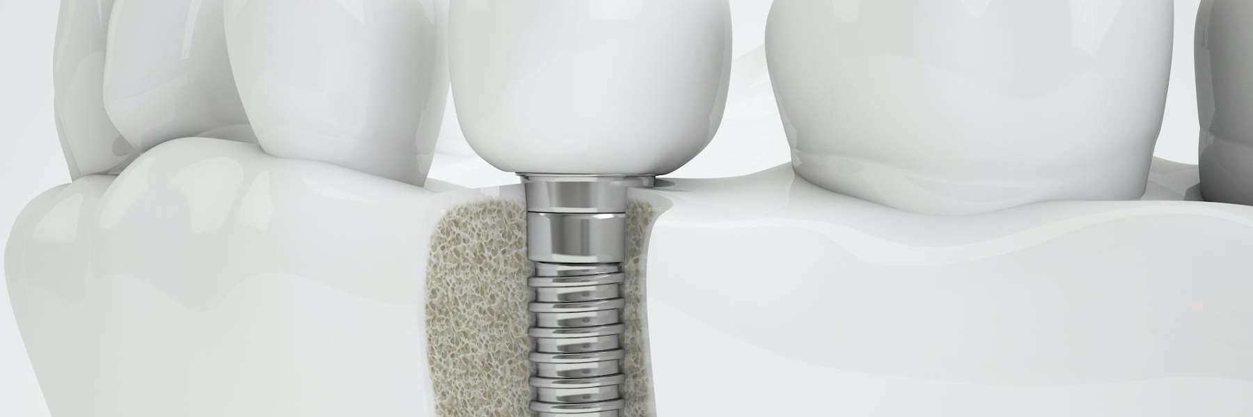 Dental implant single tooth example, nashville tn
