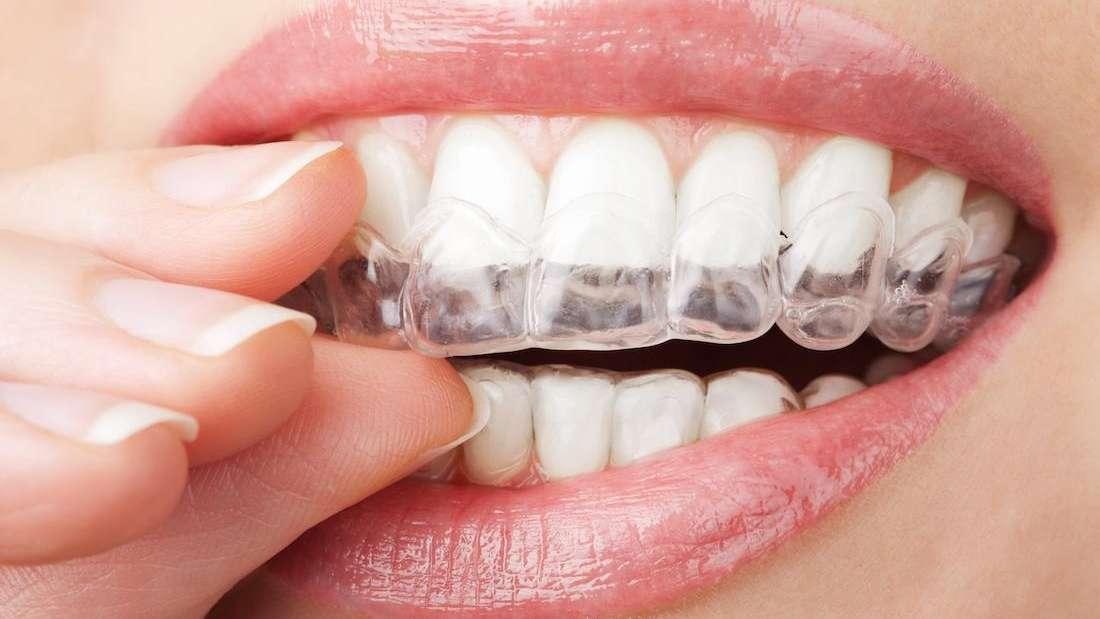 When Clear Aligners Are Better Than Traditional Braces Invisalign