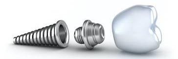 dental implant in brentwood tn