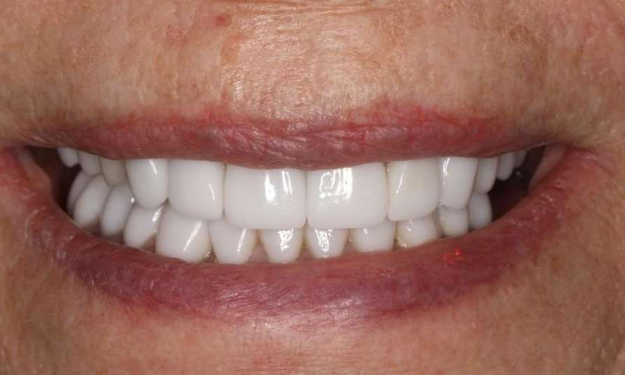 Close up view of elderly womans mouth after cosmetic crowns, brentwood tn