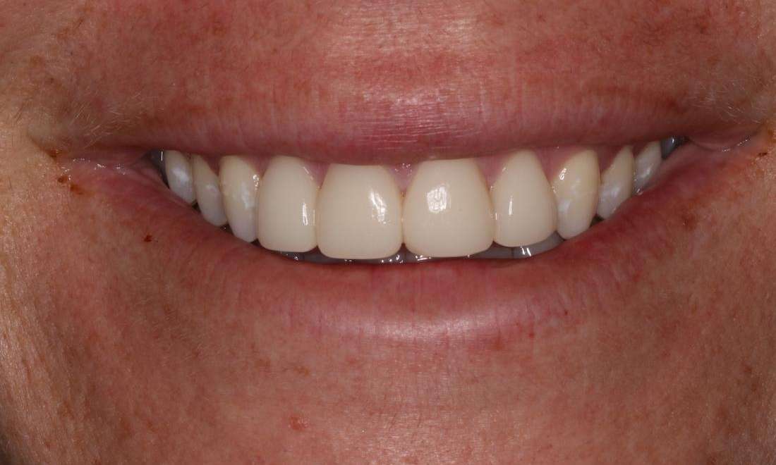 Gummy Smile Treatment with BOTOX® and Veneers Brentwood TN