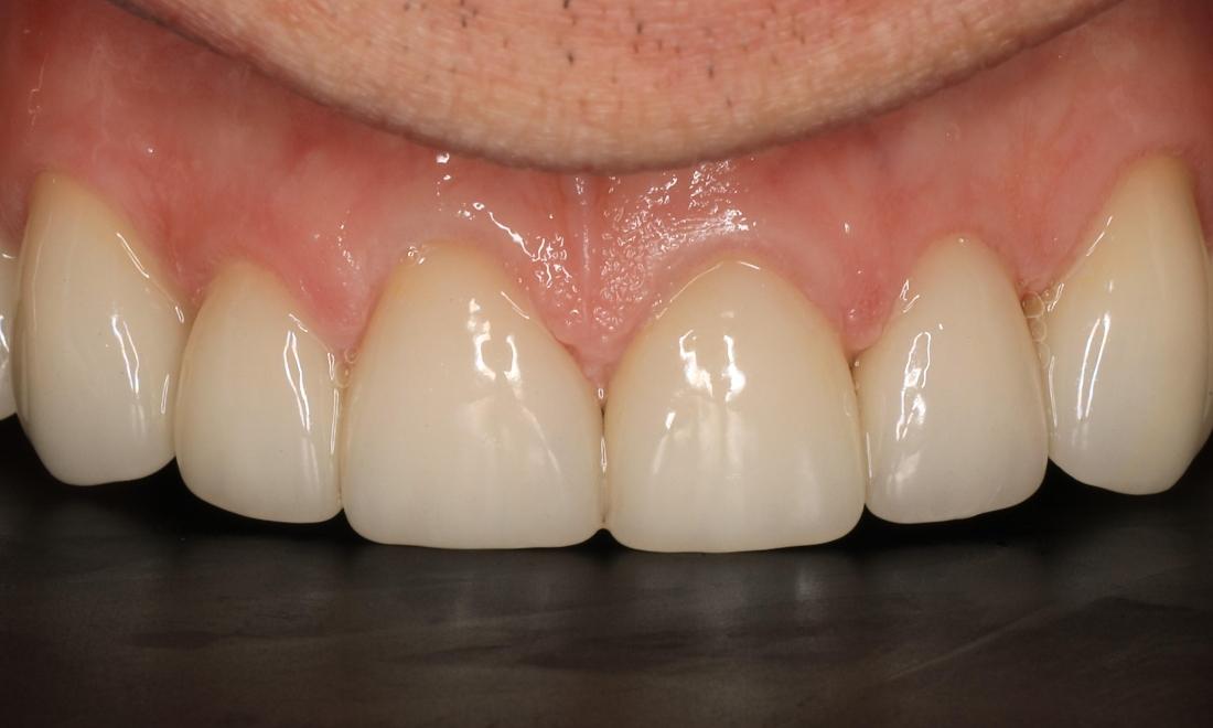 Patient teeth after getting crowns in Brentwood, TN