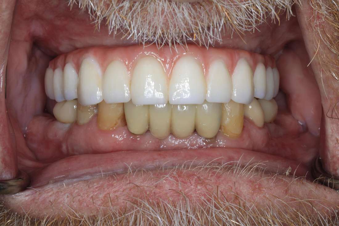 Upper Implant Supported Denture Before & After | Brentwood TN