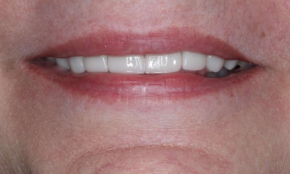 Close up of an older woman after CEREC cosmetic crowns, brentwood tn