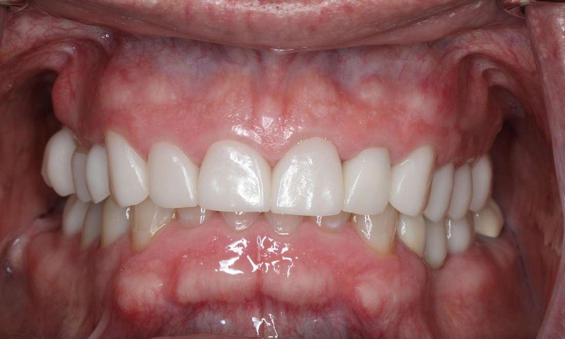 After photos of a full mouth makeover in Brentwood, TN