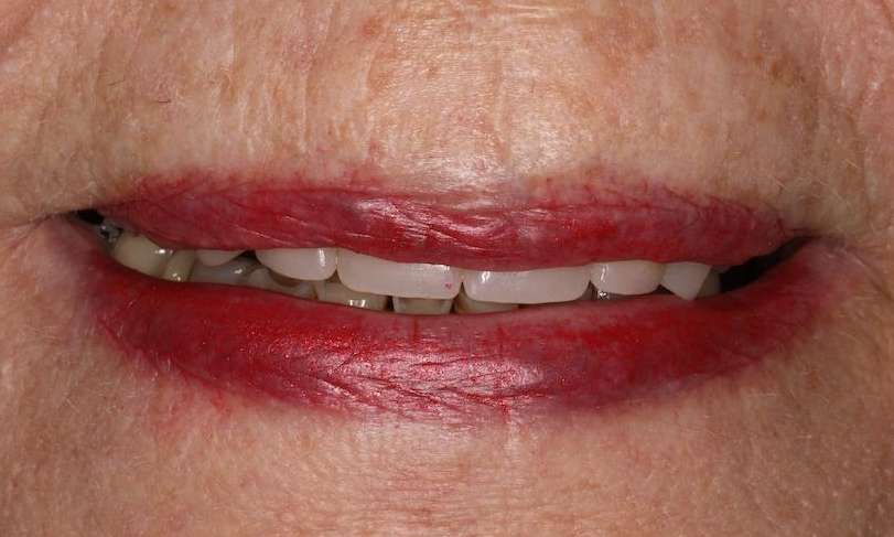 Close up view of elderly womans mouth before cosmetic crowns, brentwood tn