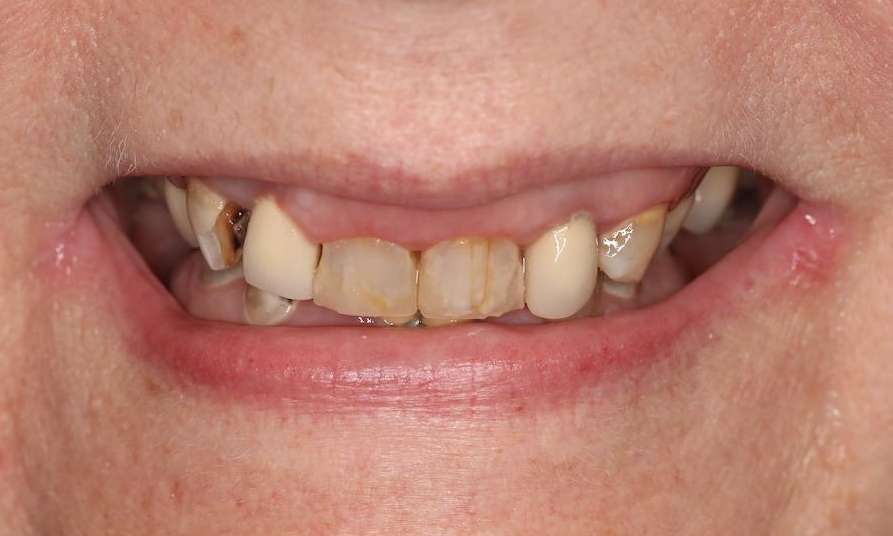 Womans mouth before implant dentures, nashville tn