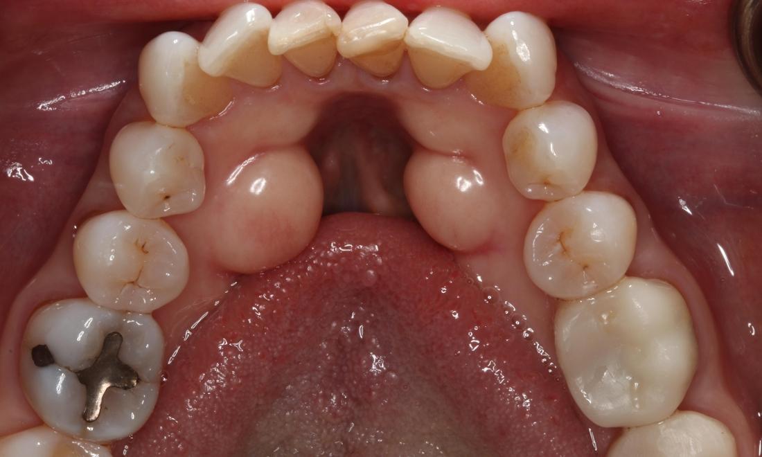 Patient before Lingual Tori Removal