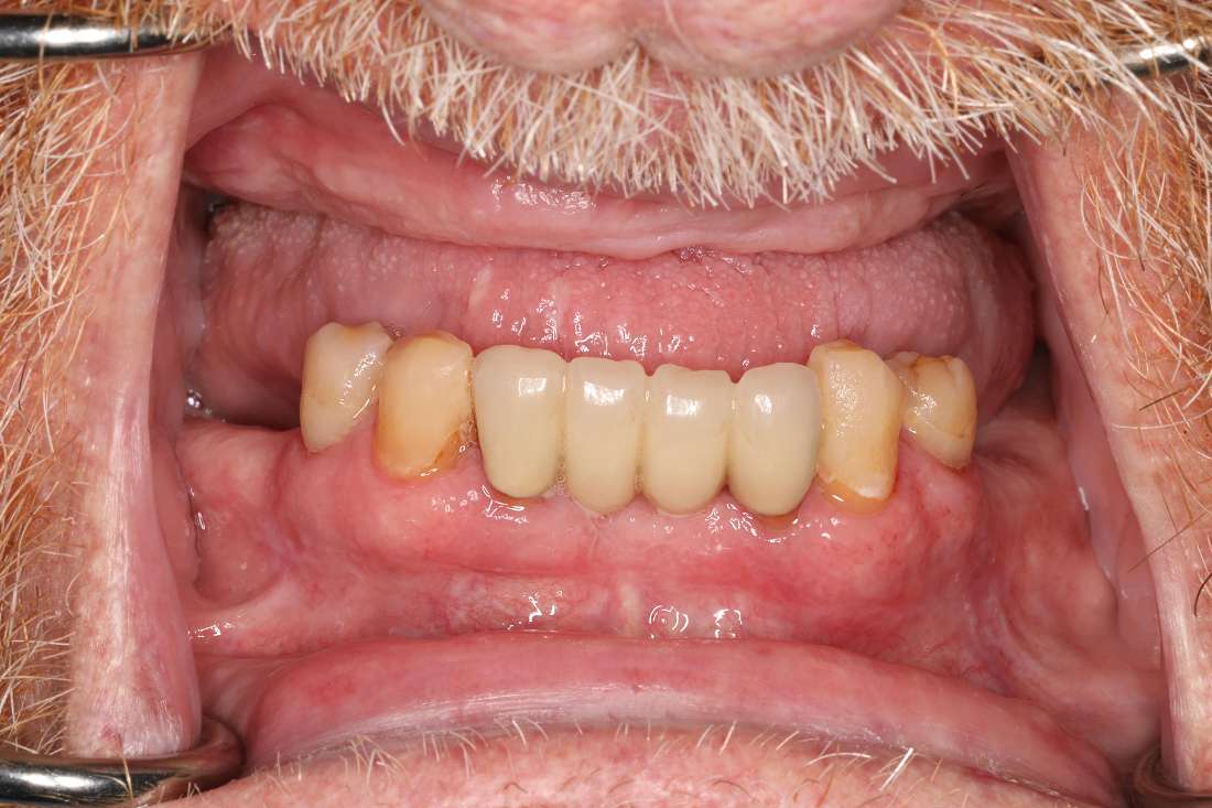 Upper Implant Supported Denture Before & After | Brentwood TN