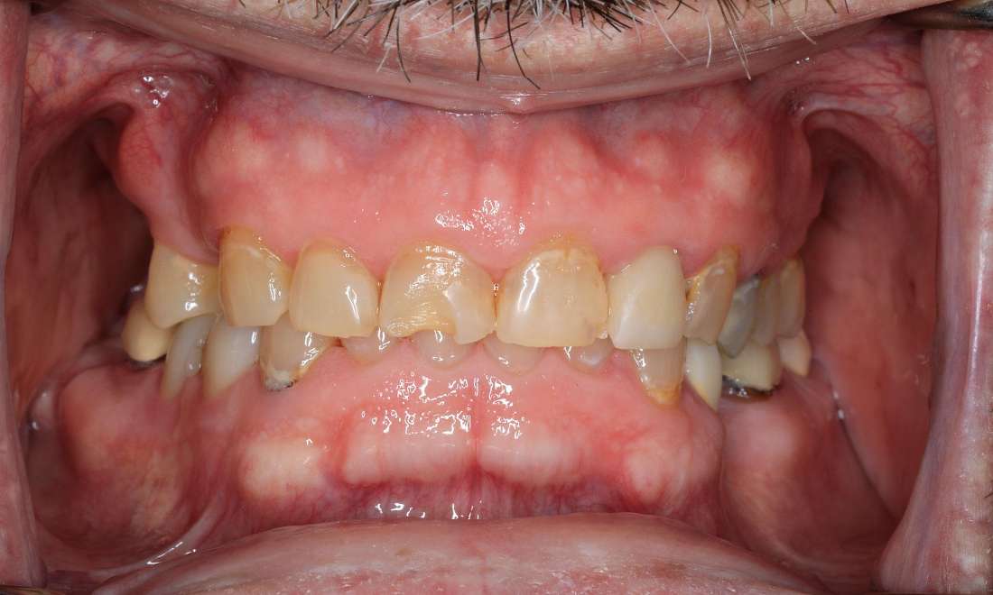 Before photos of patient's teeth in Brentwood, TN