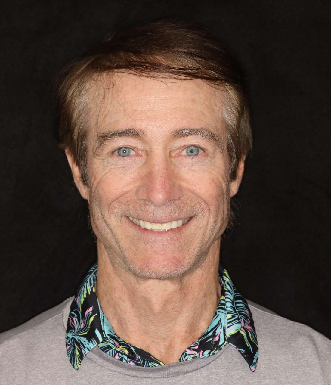 dental crowns Brentwood, TN- Before Photo