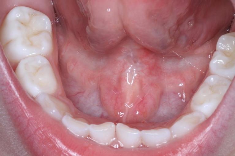 Lip-Tongue-Tie-After-Image