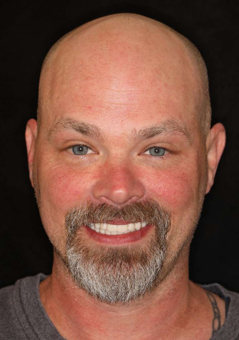 Bald man smiling after all-on-x implant dentures, nashville tn