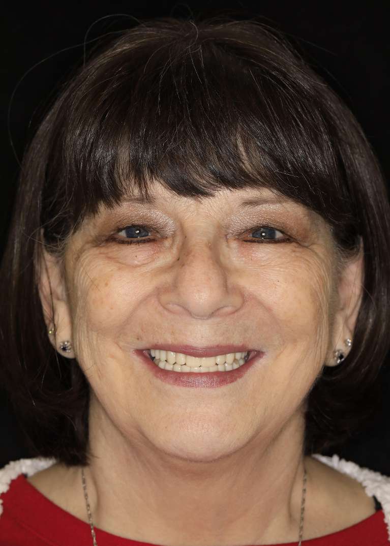 After all-on-x implants, brentwood tn