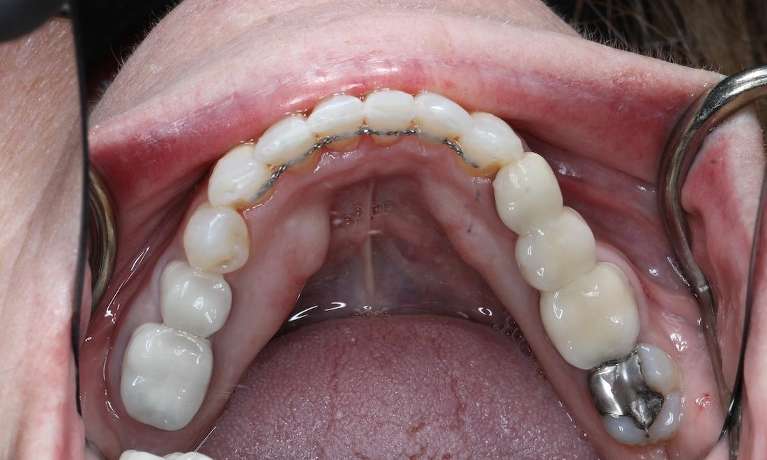 Cosmetic-Crowns-Invisalign-After-Image