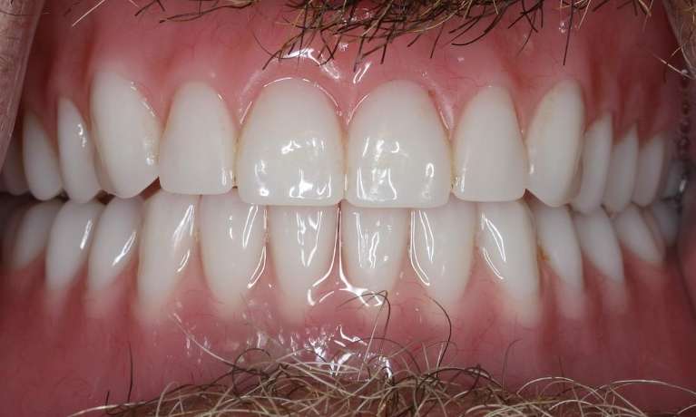 Close up of mouth after dentures, brentwood tn