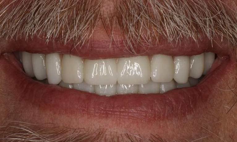 Close up of older mans mouth with mustace after implant dentures, nashville tn