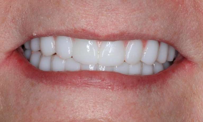 Womans mouth after implant dentures, nashville tn