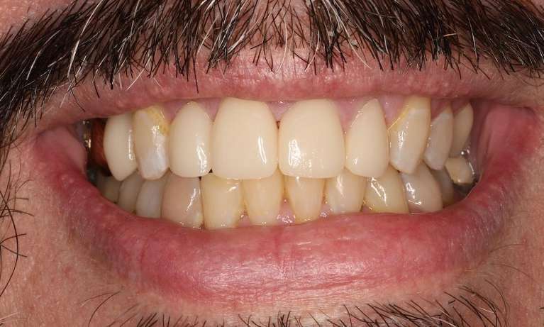 Mans mouth after invisalign and cosmetic crowns, brentwood tn