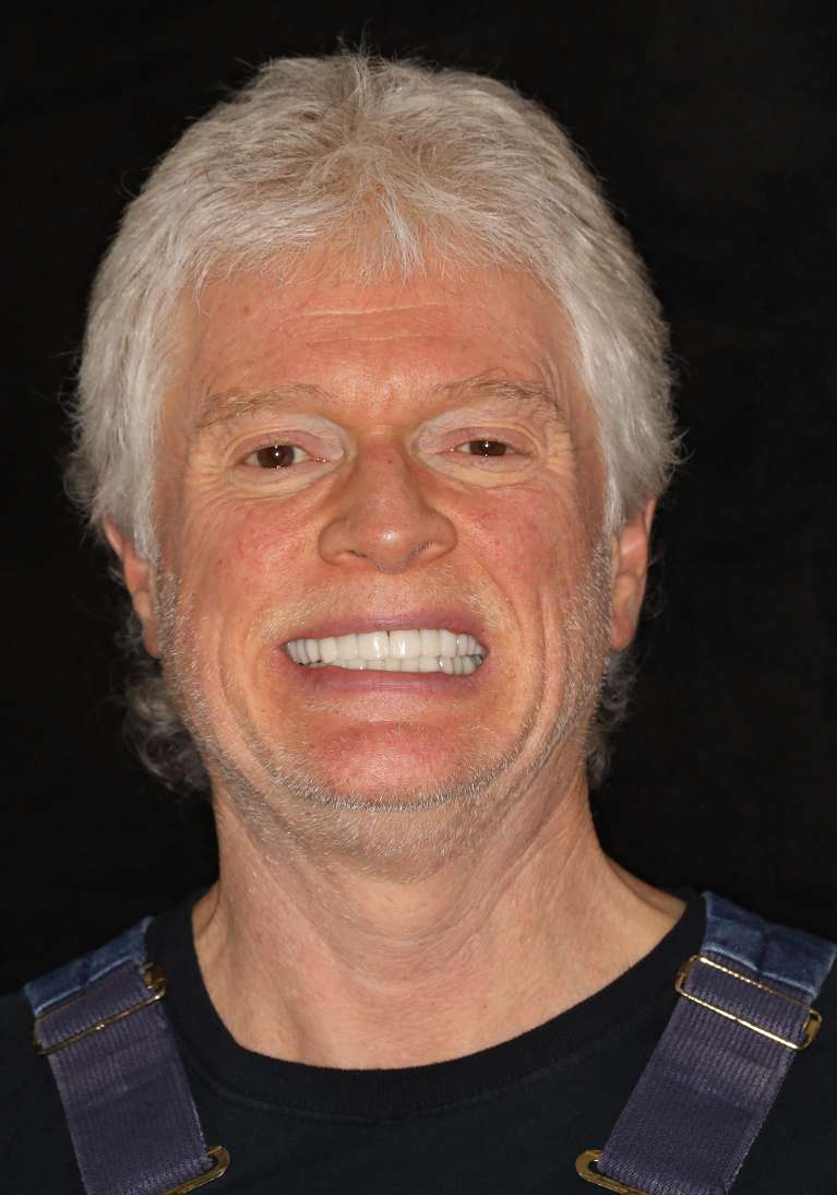 Older man smiling after a smile makeover, nashville tn