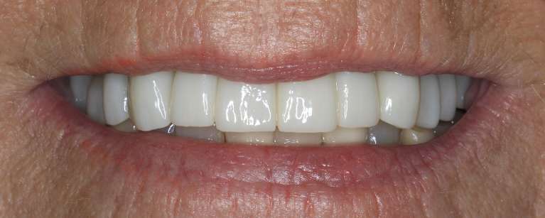 Close up view of older woman's smile after a smile makeover, nashville tn