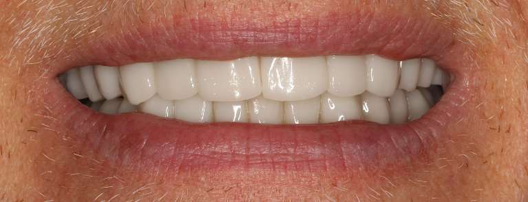 Close up view of older man smiling after a smile makeover, nashville tn