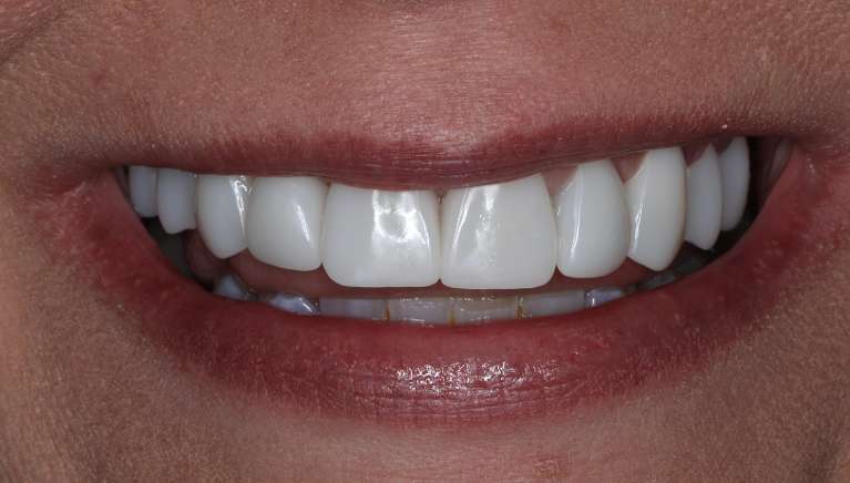 Close up of a womans mouth after a smile makeover, nashville tn