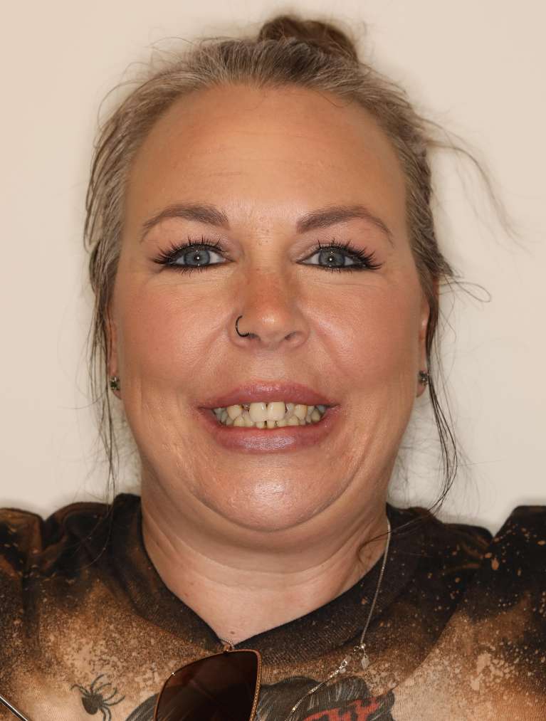 All-on-X-Implant-Dentures-Before-Image
