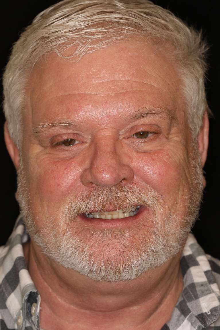Older man smiling before all-on-x implant dentures, nashville tn