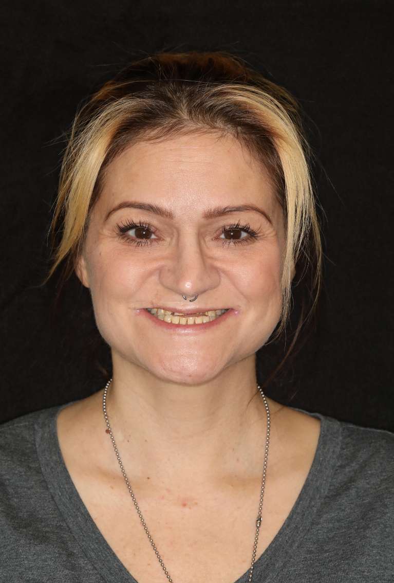 Full-Mouth-Smile-Makeover-Before-Image