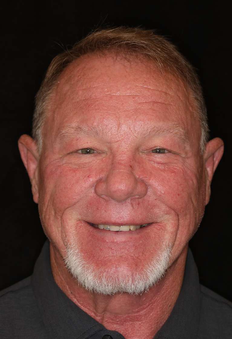 Full-Smile-Makeover-Before-Image
