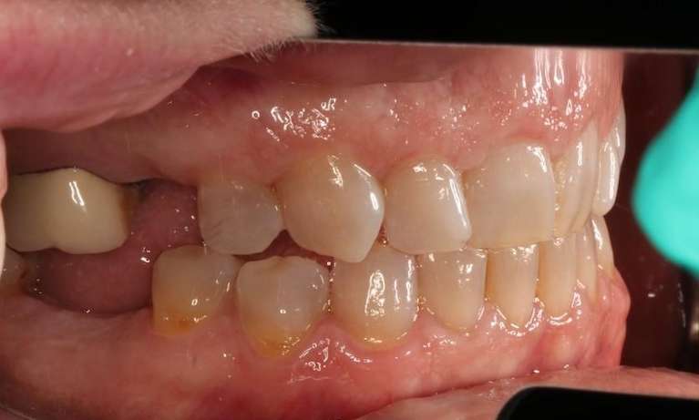 Close up of mouth before dental implants, nashville tn