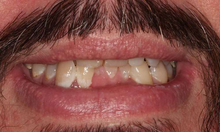 Mans mouth before invisalign and cosmetic crowns, brentwood tn
