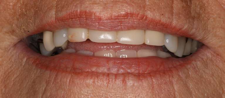 Close up view of older woman's smile before a smile makeover, nashville tn