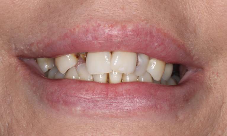 Close up view of middle aged woman smiling before all-on-x implant dentures, nashville tn
