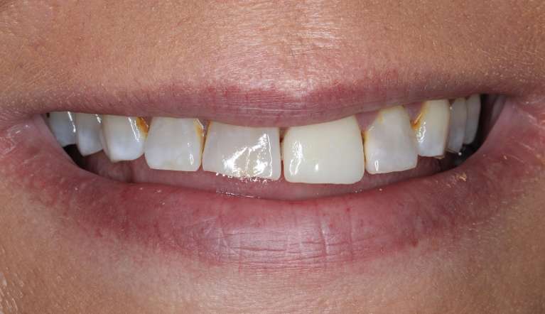 Close up of a womans mouth before a smile makeover, nashville tn