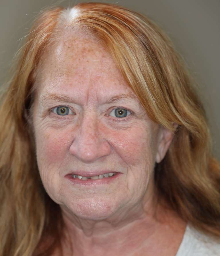 Invisalign in Brentwood, TN- Before Photo