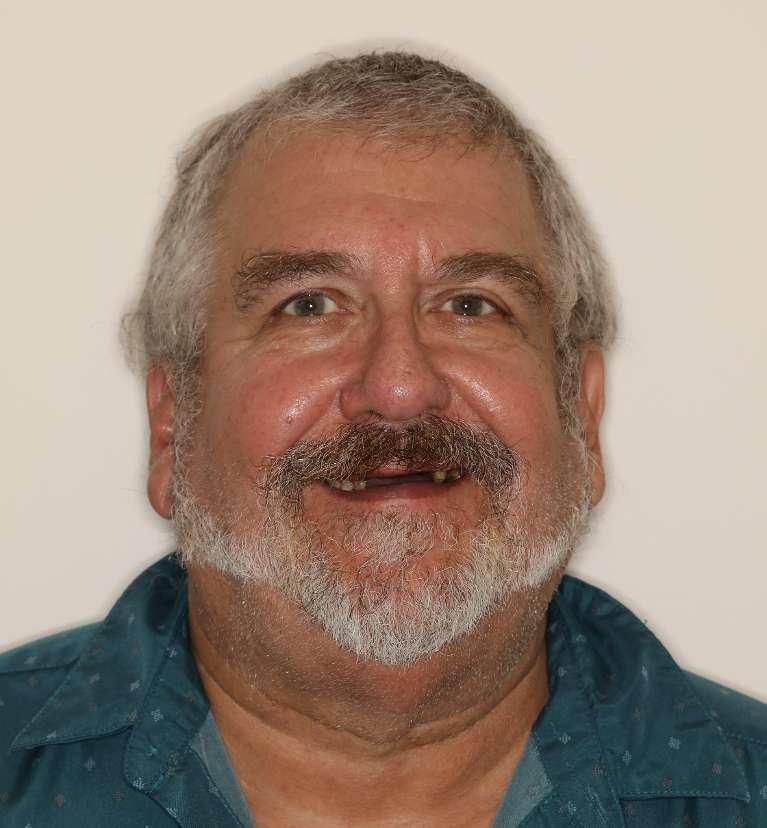 Dentures in Brentwood, TN- Before Photo