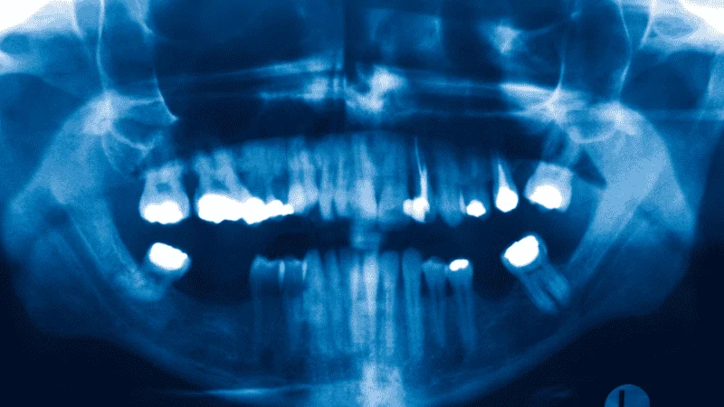 Dental Implants With Osteoporosis