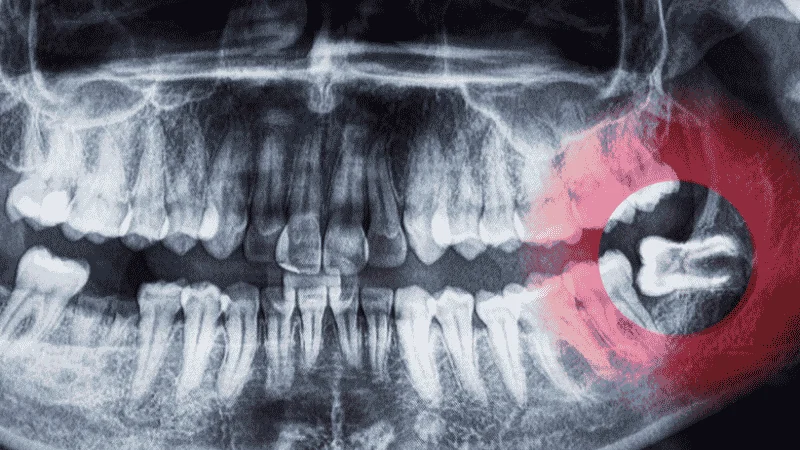 Impacted Wisdom Tooth Symptoms