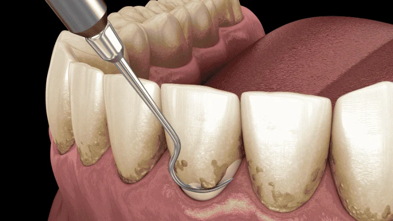 Laser Gum Disease Treatment Vs Scaling And Root Planing