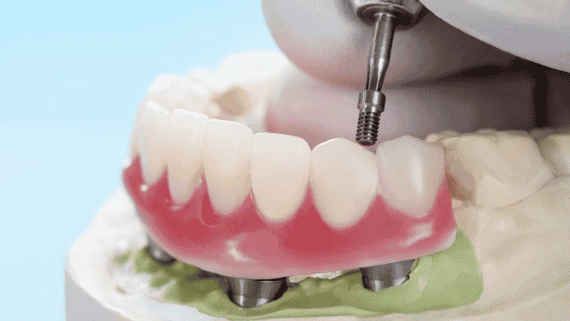 Snap In Dentures Vs Implants